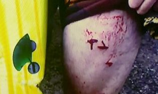 The Today Show image showing the surfers injuries.