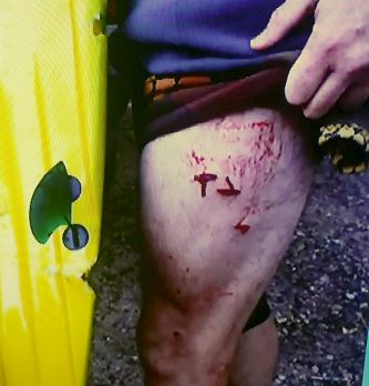 The Today Show image showing the surfers injuries.